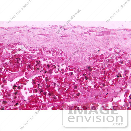 #5017 Stock Photography of Meningeal Hemorrhage due to the Anthrax Bacteria by JVPD