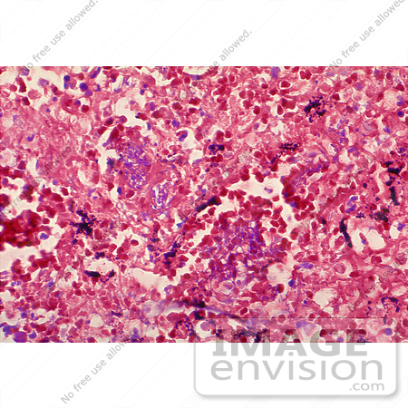 #5020 Stock Photography of Histopathology of Mediastinal Lymph Node in Fatal Human Anthrax by JVPD