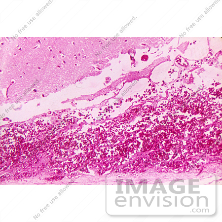 #5021 Stock Photography of Hemorrhagic Meningitis due to the Fatal Inhalation Anthrax by JVPD