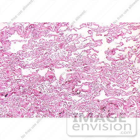 #5022 Stock Photo of Micrograph of the Fatal Inhalation of Anthrax in a Person by JVPD