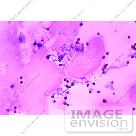 #5024 Stock Photography of Human Meningitis with the Presence of Bacillus Anthracis by JVPD