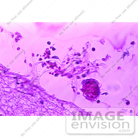 #5025 Stock Photography of Mild Meningitis with Hemorrhage due to Bacillus Anthracis by JVPD