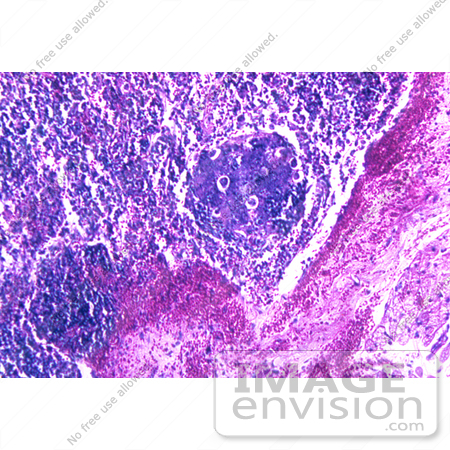 #5026 Stock Photography of Hemorrhagic Lymph Node Due To Inhalation Anthrax by JVPD