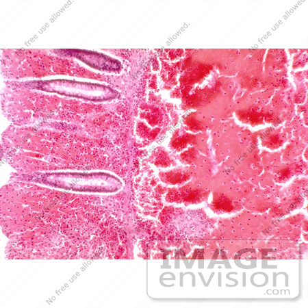 #5027 Stock Phtography - Histopathology Of Large Intestine In Fatal Human Anthrax by JVPD