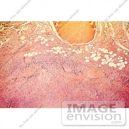 #5028 Stock Photography - Necrosis Of Lymph Node Due To Anthrax by JVPD