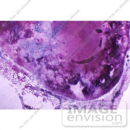 #5032 Stock Photography of Hemorrhagic Necrosis of a Lymph Node due to the Anthrax Disease by JVPD