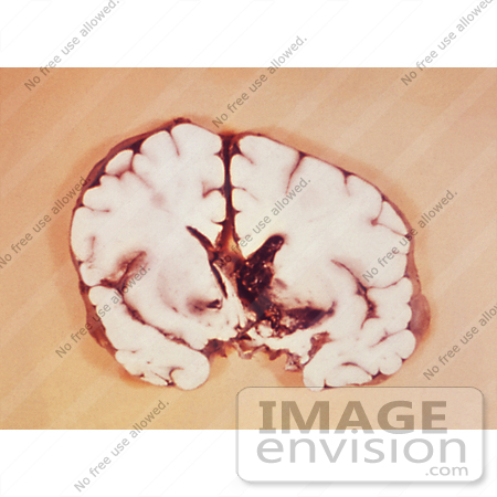 #5049 Stock Photography of a Brain Slice Revealing an Interventricular Hemorrhage by JVPD