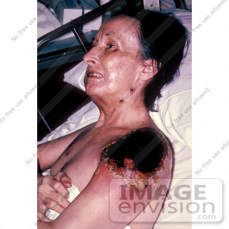 #5090 Stock Photography of a Female Patient with Vaccinia Gangrenosum by JVPD