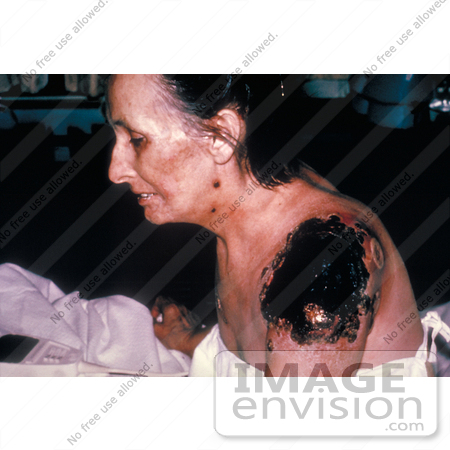 #5093 Stock Photography of an Ill Patient with Life Threatening Progressive Vaccinia Gangrenosum by JVPD
