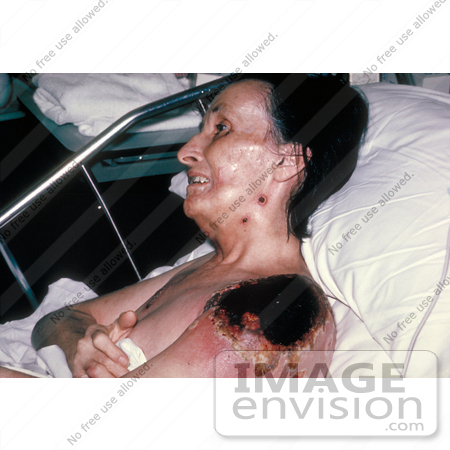 #5094 Stock Photo of  Progressive Vaccinia Gangrenosum On the Shoulder of a Woman by JVPD