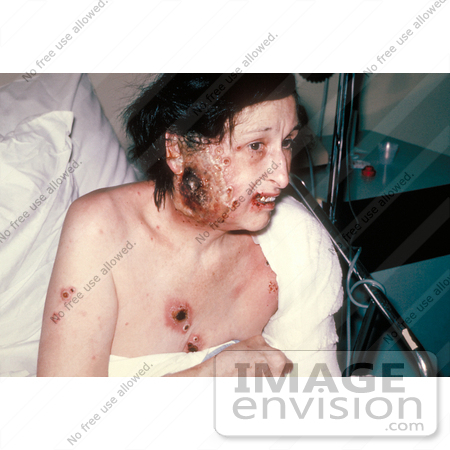 #5096 Picture of a Woman Showing Severe Complications of a Smallpox Vaccination by JVPD