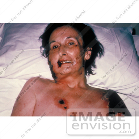 #5099 Stock Photography of a Female Patient with Progressive Vaccinia from a Smallpox Vaccination by JVPD