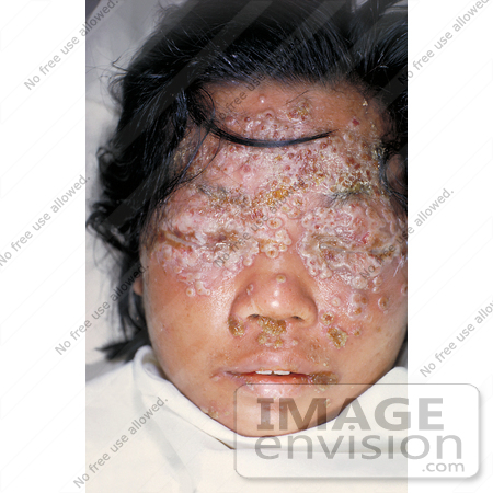 #5107 Stock Photography of a 28 Year Old Woman with Eczema Vaccinatum by JVPD