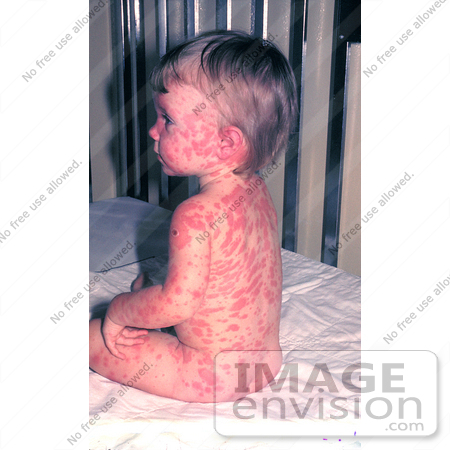 #5118 Picture of a Child that Developed Rrythema Multiforme from a Smallpox Vaccination by JVPD