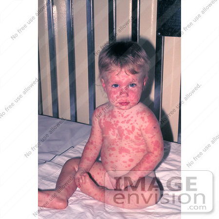 #5119 Stock Photography of a Child That Developed a Severe Rash from a Smallpox Vaccine by JVPD