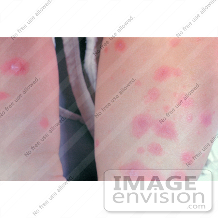 #5121 Stock Photography of Erythema Multiforme on the Legs of a Child by JVPD