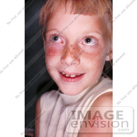 #5127 Stock Photography of a Child with a Case of Autoinoculation of Her Cheek after being Vaccinated with Vaccinia by JVPD