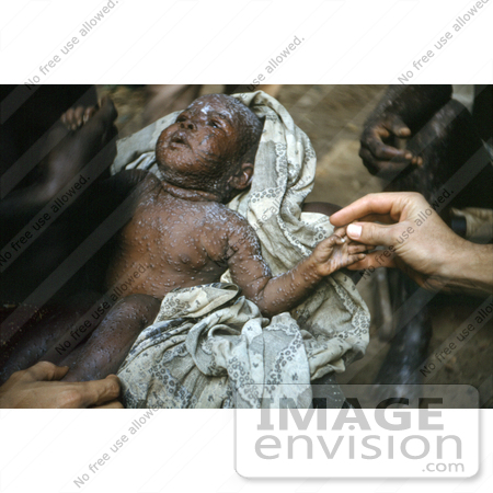 #7475 Picture of a Nigerian Child Suffering From Smallpox During the Biafran War by KAPD
