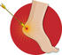 #33639 Clip Art Graphic of an Arrow Hitting A Person’s Heel, Over A Red Circle by Maria Bell