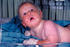 #5117 Stock Photograpy of an 8 Month Old Infant with a Widespread Rash from a Generalized Vaccinia Reaction by JVPD