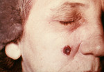 Woman with an Anthrax Skin Lesion on the 13th Day