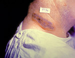 Anthrax Neck Skin Lesion