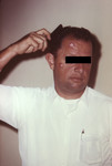 Man with Cutaneous Anthrax Due to Bacillus Anthracis