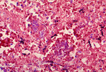 Histopathology of Mediastinal Lymph Node in Fatal Human Anthrax