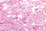 Micrograph of the Fatal Inhalation of Anthrax in a Person