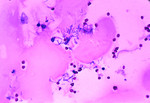 Human Meningitis with the Presence of Bacillus Anthracis