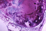 Hemorrhagic Necrosis of a Lymph Node due to the Anthrax Disease