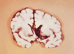 Brain Slice Revealing an Interventricular Hemorrhage