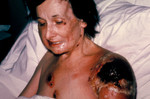 Patient Progressive Vaccinia After Being Vaccinated for Smallpox
