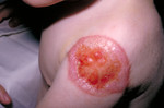 Patient with Progressive Vaccinia On His Shoulder