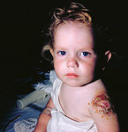 Kid with Progressive Vaccinia On His Arm