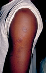 Person with Secondary Herpes Infection On His Arm