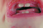 Child with the Stevens-Johnson Syndrome