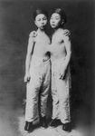 Korean Siamese Twins