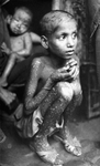 Kid with Smallpox Disease