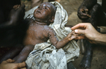 Nigerian Child Suffering From Smallpox During the Biafran War