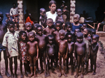 Nurse Standing with a Group of African Children Showing Symptoms of the Protein-Deficiency Disease Kwashiorkor