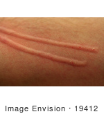#19412 Stock Photo Of A Man’S Skin On His Arm Raised After A Cat Scratch