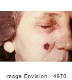 #4970 Stock Photography Of An Woman With An Anthrax Skin Lesion On The 13th Day