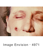 #4971 Stock Photography Of An Woman With An Anthrax Skin Lesion On The 5th Day