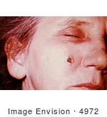 #4972 Stock Photography Of An Woman With An Anthrax Skin Lesion On The 8th Day