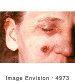 #4973 Stock Photography Of An Woman With An Anthrax Skin Lesion On The 11th Day