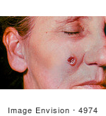 #4974 Stock Photography Of An Woman With An Anthrax Skin Lesion On The 6th Day