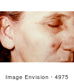 #4975 Stock Photography Of An Woman With An Anthrax Skin Lesion On The 4th Day