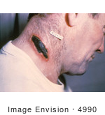 #4990 Stock Photography Of A Man With A Cutaneous Anthrax Lesion On His Neck