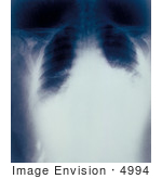 #4994 Stock Photography Of A Radiograph Of Anthrax Inhalation
